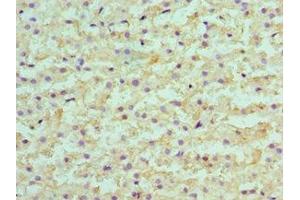 Immunohistochemistry of paraffin-embedded human liver cancer using ABIN7145594 at dilution of 1:100 (SULT2A1 antibody  (AA 1-145))