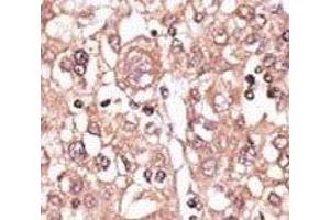 IHC analysis of FFPE human hepatocarcinoma tissue stained with the anti-TLR7 antibody (TLR7 antibody  (AA 98-128))