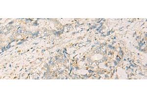 Immunohistochemistry of paraffin-embedded Human cervical cancer tissue using WDR37 Polyclonal Antibody at dilution of 1:50(x200) (WDR37 antibody)