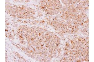 IHC-P Image NDUFS5 antibody detects NDUFS5 protein at mitochondria on human lung adenocarcinoma by immunohistochemical analysis. (NDUFS5 antibody  (Center))