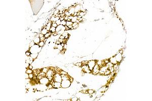 Immunohistochemistry of paraffin-embedded human liver using [KO Validated] Cytokeratin 8 Rabbit pAb (ABIN3021287, ABIN3021288, ABIN3021289, ABIN1513142 and ABIN1514287) at dilution of 1:50 (40x lens). (KRT8 antibody  (AA 1-483))