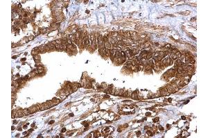 IHC-P Image Thymidylate synthetase antibody detects Thymidylate synthetase protein at cytosol and nucleus on human ovarian carcinoma by immunohistochemical analysis.