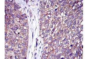Immunohistochemical analysis of paraffin-embedded bladder cancer tissues using C-CBL mouse mAb with DAB staining.