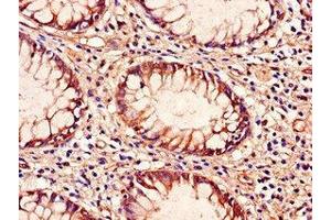 Immunohistochemistry of paraffin-embedded human colon cancer using ABIN7172286 at dilution of 1:100 (TLR9 antibody  (AA 425-563))