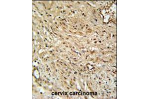RPA43 Antibody immunohistochemistry analysis in formalin fixed and paraffin embedded human cervix carcinoma followed by peroxidase conjugation of the secondary antibody and DAB staining. (TWIST Neighbor antibody  (C-Term))