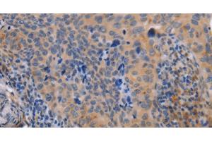 Immunohistochemistry of paraffin-embedded Human cervical cancer tissue using MAP3K13 Polyclonal Antibody at dilution 1:40 (MAP3K13 antibody)