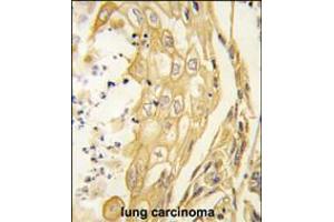 Formalin-fixed and paraffin-embedded human lung carcinoma tissue reacted with the EphB4 antibody , which was peroxidase-conjugated to the secondary antibody, followed by DAB staining.