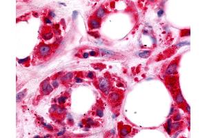 Anti-HUNK / B19 antibody IHC of human Breast, Carcinoma. (HUNK antibody  (Kinase Domain))