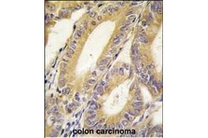 Formalin-fixed and paraffin-embedded human colon carcinoma tissue reacted with BIRC4 antibody (N-term) (ABIN390070 and ABIN2840594) , which was peroxidase-conjugated to the secondary antibody, followed by DAB staining. (XIAP antibody  (N-Term))