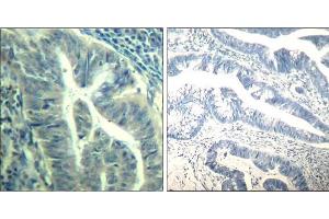 Immunohistochemical analysis of paraffin-embedded human colon carcinoma tissue using CDK6 (phospho-Tyr24) Antibody (E011543). (CDK6 antibody  (pTyr24))