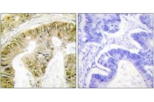 Immunohistochemistry analysis of paraffin-embedded human colon carcinoma, using FANCA (Phospho-Ser1149) Antibody. (FANCA antibody  (pSer1149))