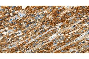 Immunohistochemistry of paraffin-embedded Human esophagus cancer using CAV1 Polyclonal Antibody at dilution of 1:40 (Caveolin-1 antibody)