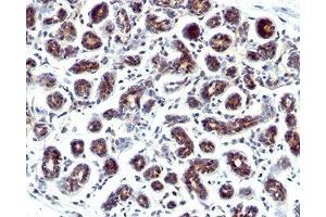 IHC staining of human breast cancer with Estrogen Inducible Protein pS2 antibody. (TFF1 antibody  (C-Term))