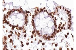 ABIN6267280 at 1/100 staining human Colon carcinoma tissue sections by IHC-P. (RAF1 antibody  (pSer296))