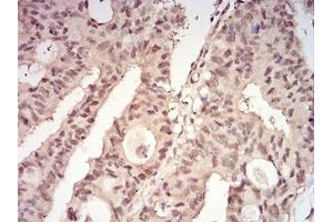 Immunohistochemical analysis of paraffin-embedded rectum cancer tissues using YWHAB mouse mAb with DAB staining. (YWHAB antibody  (AA 1-246))
