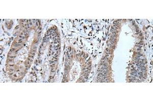 Immunohistochemistry of paraffin-embedded Human liver cancer tissue using UBA52 Polyclonal Antibody at dilution of 1:55(x200) (UBA52 antibody)