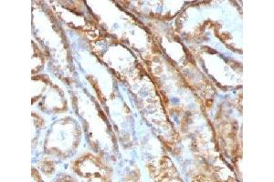 IHC testing of FFPE human renal cell carcinoma with Mitochondrial antibody (GFM1 antibody)