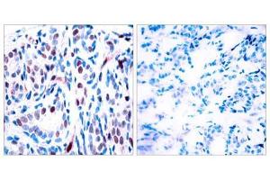 Immunohistochemical analysis of paraffin-embedded human breast carcinoma tissue using STAT3 (phospho-Tyr705) antibody (E011045). (STAT3 antibody  (pTyr705))