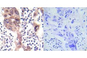 Immunohistochemical analysis of paraffin-embedded human breast carcinoma tissue using LKB1 (phospho- Ser428) antibody (E012046). (LKB1 antibody  (pSer428))