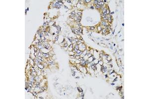 Immunohistochemistry of paraffin-embedded human gastric cancer using CHN1 antibody (ABIN5974737) at dilution of 1/100 (40x lens). (CHN1 antibody)