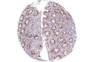 Appendix mucosa showing a strong granular cytoplasmic SDHA positivity of all epithelial cells while staining is weak to moderate in lymphocytes