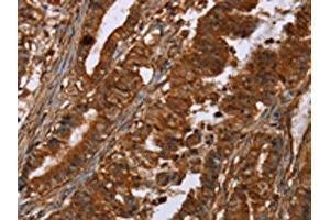 The image on the left is immunohistochemistry of paraffin-embedded Human esophagus cancer tissue using ABIN7191964(POU6F2 Antibody) at dilution 1/30, on the right is treated with synthetic peptide.