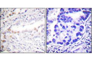 Immunohistochemistry analysis of paraffin-embedded human lung carcinoma tissue using Uba2 antibody.