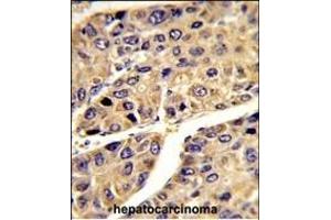 Formalin-fixed and paraffin-embedded human hepatocarcinoma reacted with IGFALS Antibody (Center), which was peroxidase-conjugated to the secondary antibody, followed by DAB staining. (IGFALS antibody  (AA 308-335))