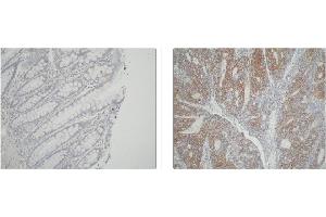 Left and Center: Immunohistochemical staining of normal colon tissue and colon carcinoma tissue using ATIC antibody . (ATIC antibody)