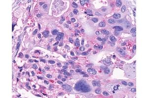 Anti-GPR150 antibody IHC of human Pancreas, Carcinoma. (GPR150 antibody  (N-Term))