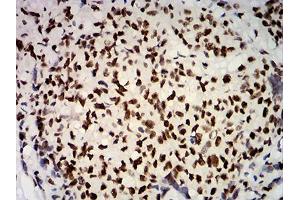 Immunohistochemical analysis of paraffin-embedded breast cancer tissues using ESR1 mouse mAb with DAB staining. (Estrogen Receptor alpha antibody  (AA 2-185))