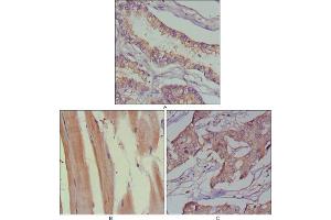 Immunohistochemical analysis of paraffin-embedded human lung cancer (A), muscles (B) and breast cancer (C) using MUSK mouse mAb with DAB staining.