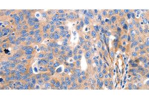 Immunohistochemistry of paraffin-embedded Human ovarian cancer tissue using IGFBP7 Polyclonal Antibody at dilution 1:50 (IGFBP7 antibody)