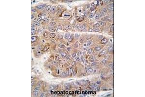 Formalin-fixed and paraffin-embedded human hepatocarcinoma tissue reacted with IRS2 antibody (C-term), which was peroxidase-conjugated to the secondary antibody, followed by DAB staining.