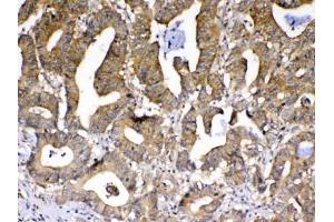 IHC testing of FFPE human rectal cancer tissue with PPID antibody at 1ug/ml.