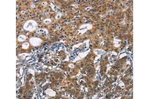 Immunohistochemistry of Human liver cancer using DCC Polyclonal Antibody at dilution of 1:70 (DCC antibody)