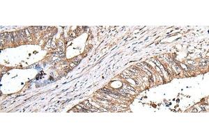Immunohistochemistry of paraffin-embedded Human colorectal cancer tissue using ZNHIT1 Polyclonal Antibody at dilution of 1:40(x200) (ZNHIT1 antibody)