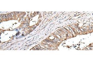 Immunohistochemistry of paraffin-embedded Human colorectal cancer tissue using ZNHIT1 Polyclonal Antibody at dilution of 1:40(x200) (ZNHIT1 antibody)