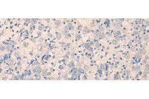Immunohistochemistry of paraffin-embedded Human cervical cancer tissue using FAM91A1 Polyclonal Antibody at dilution of 1:35(x200) (FAM91A1 antibody)