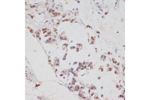 Immunohistochemistry of paraffin-embedded human gastric cancer using HT antibody (ABIN7267756) at dilution of 1:100 (40x lens). (HTATSF1 antibody  (AA 1-180))