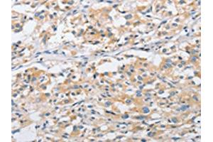 The image on the left is immunohistochemistry of paraffin-embedded Human thyroid cancer tissue using ABIN7128506(ARHGEF9 Antibody) at dilution 1/50, on the right is treated with fusion protein. (Arhgef9 antibody)