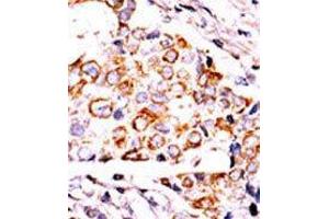 Formalin-fixed and paraffin-embedded human cancer tissue reacted with the primary antibody, which was peroxidase-conjugated to the secondary antibody, followed by DAB staining. (NME3 antibody  (AA 59-88))