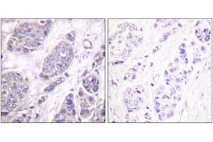 Immunohistochemistry analysis of paraffin-embedded human breast carcinoma tissue, using TGF beta3 Antibody. (TGFB3 antibody  (AA 261-310))