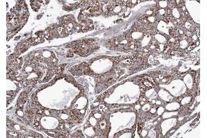 IHC-P Image Immunohistochemical analysis of paraffin-embedded gastric cancer N87 xenograft, using AK3L1, antibody at 1:100 dilution. (AK4 antibody)