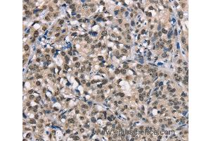 Immunohistochemistry of Human esophagus cancer using NDNL2 Polyclonal Antibody at dilution of 1:40