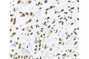 Immunohistochemistry of paraffin-embedded Human lung cancer using JNK1 Polyclonal Antibody at dilution of 1:100 (40x lens). (JNK antibody)