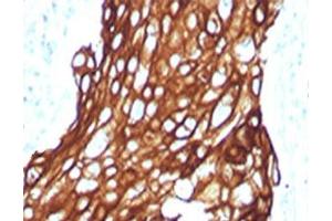 IHC testing of FFPE human lung carcinoma with Acidic Cytokeratin antibody. (Recombinant Keratin Acidic (AE1) antibody)