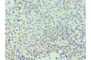 Immunohistochemistry of paraffin-embedded human breast cancer using ABIN7147585 at dilution of 1:100 (CLIC1 antibody  (AA 42-241))