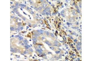 Immunohistochemistry of paraffin-embedded Human gastric cancer using AIMP1 Polyclonal Antibody at dilution of 1:100 (40x lens). (AIMP1 antibody)