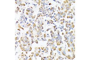 使用RHOG抗体（ABIN7269864）在1:100（40倍晶状体）稀释度下对石蜡包埋的人类肝癌进行免疫组织化学研究。（RHOG抗体）